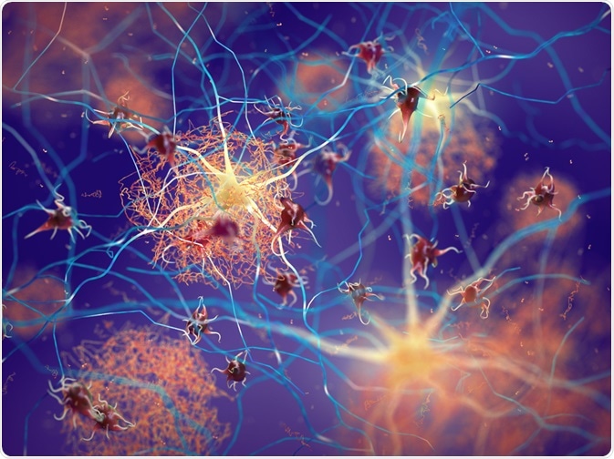 amyloid plaques