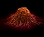 What is a Diffuse Intrinsic Pontine Glioma (DIPG)?