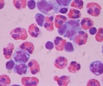No inflammation of cerebrospinal fluid in COVID-19 patients with neurological features, study finds