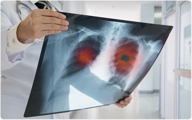lung pathogenesis