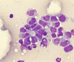 Sarcomas - Latest Developments in Diagnosis and Treatment