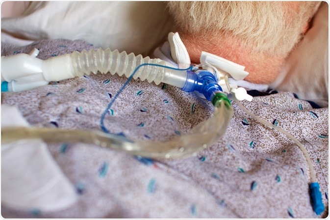 Tracheotomy