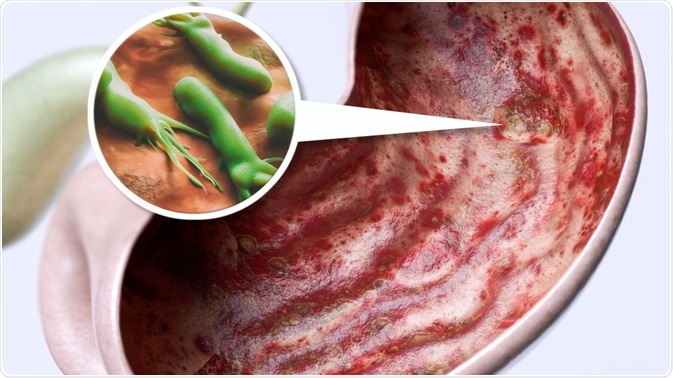 helicobacter pylori