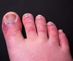 Chilblain-like lesions and COVID-19