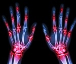 Raptiva, 20 percent improvement in an individual's signs and symptoms of arthritis.
