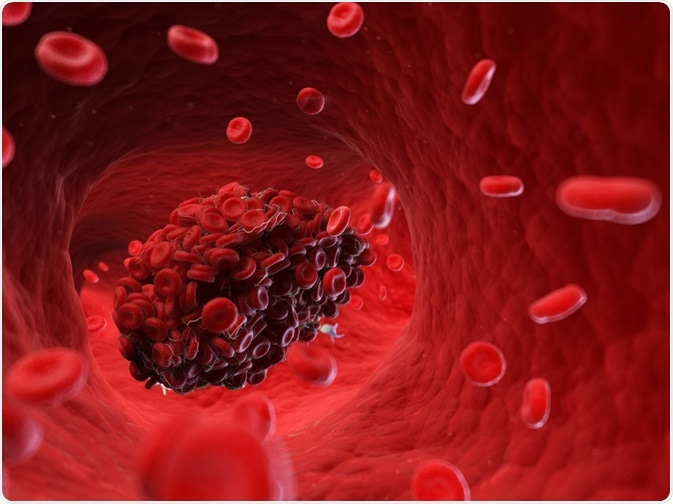 Blood Clot