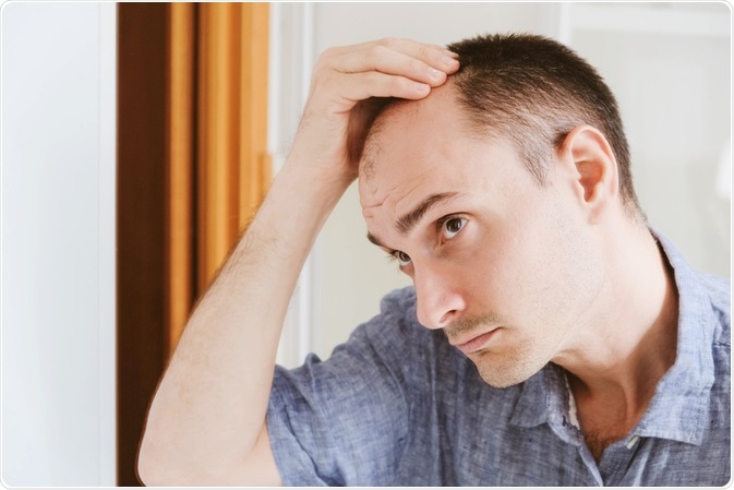 Male Pattern Baldness Male Pattern Baldness