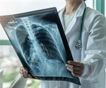 Correlation between idiopathic pulmonary fibrosis and COVID-19