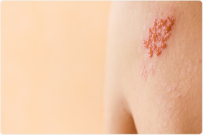 Shingles Shingles