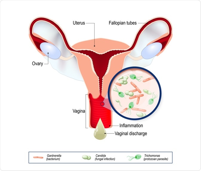 vaginitis