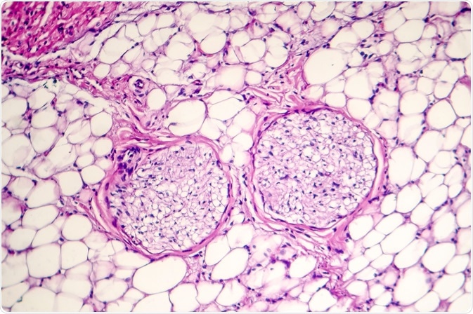 pericarditis