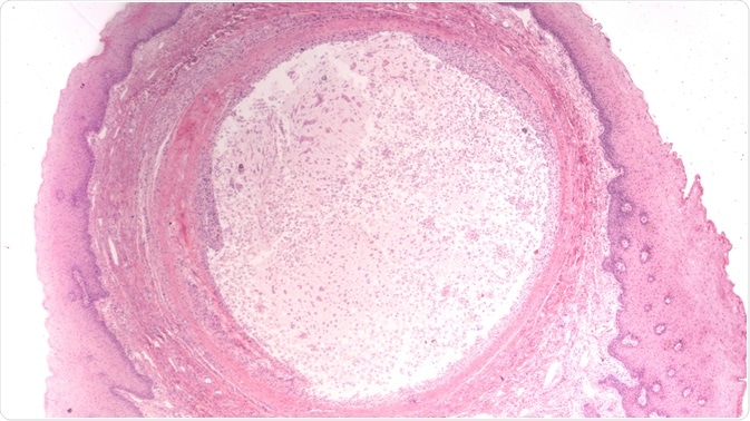 mucocele