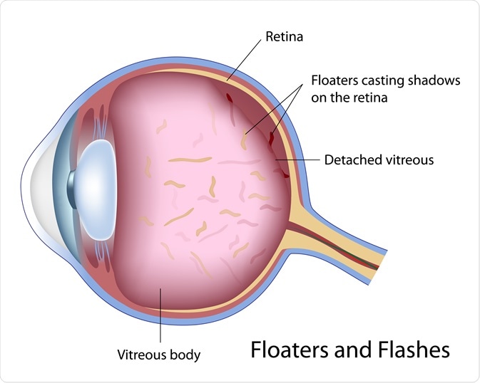 eye floaters