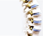 Spina Bifida Epidemiology
