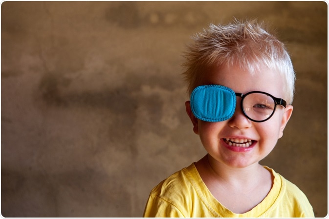 strabismus