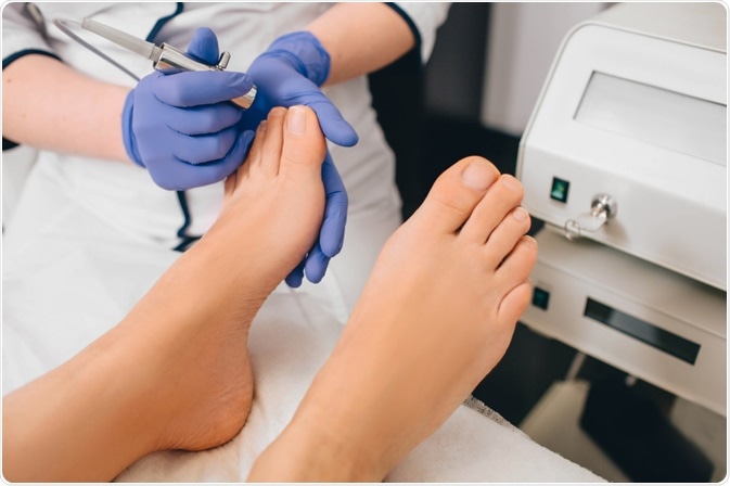 onychomycosis