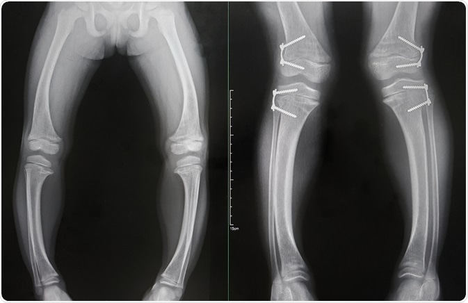 rickets