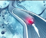 Restenosis Treatment