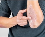 Psoriasis Prognosis