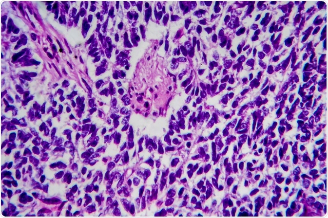 wilms tumor