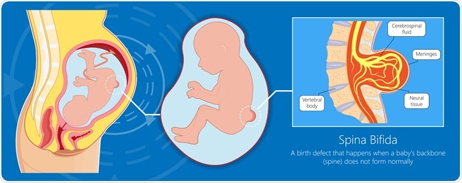 spina bifida