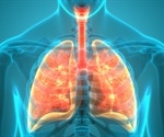 Sarcoidosis Treatment