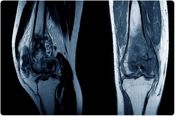 osteosarcoma