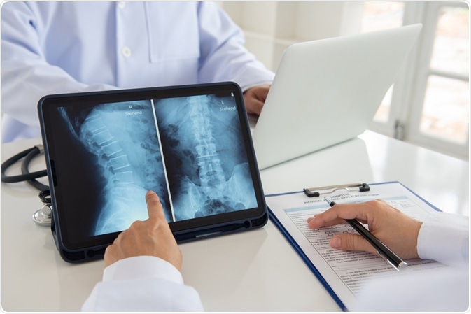paraplegia