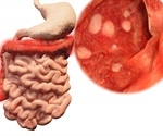 Infliximab and Ulcerative Colitis