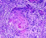 Squamous Cell Carcinoma Symptoms