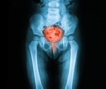 Cystitis Symptoms