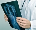 Noonan Syndrome Symptoms