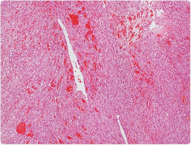 angiosarcoma