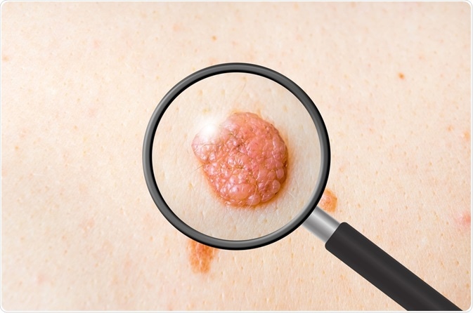 skin tumor