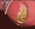 Gallstone Symptoms