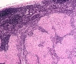 Sarcoidosis Prognosis