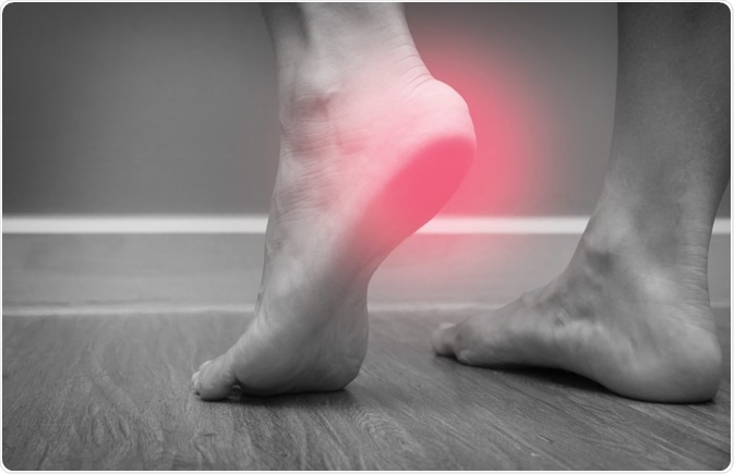 Plantar fasciitis Plantar fasciitis