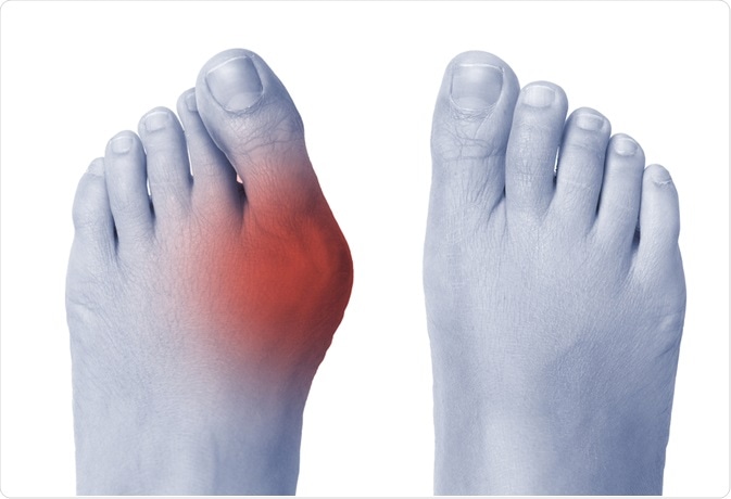 bunion