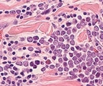 What is Merkel Cell Carcinoma?