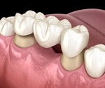 Uses for a Dental Bridge
