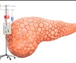Pancreatitis Prognosis