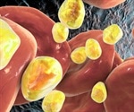 Hypertriglyceridemia Treatment