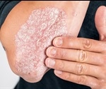 Psoriasis Epidemiology