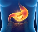 Gastritis Diagnosis
