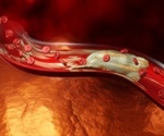 What is Peripheral Arterial Disease?