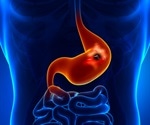 What are Peptic Ulcers?