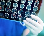 Treatment Strategies for Von-Hippel-Lindau Syndrome