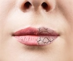 Actinic Cheilitis Prevention