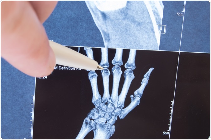 juvenile arthritis