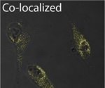 Study indicates an amyloid link between melanoma and Parkinson’s disease